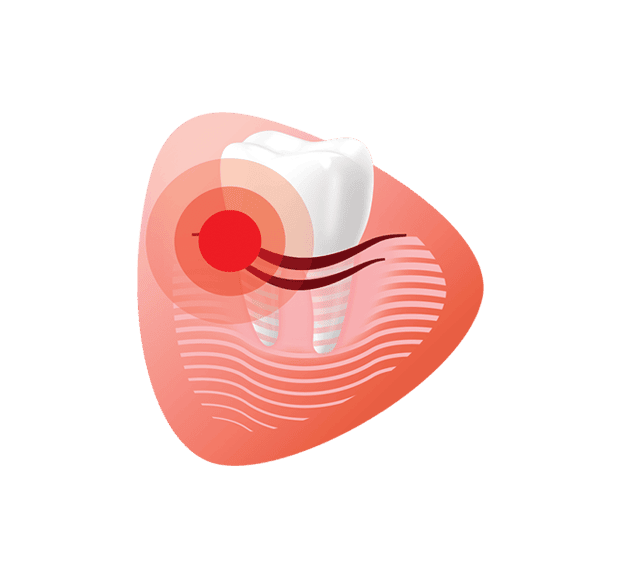 Ilustrácia zubu s červenou bodkou označujúcou bolesť alebo problém
